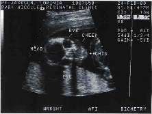 Baby Ultrasound face.jpg (17483 bytes)