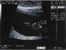 Baby Ultrasound feet.jpg (16199 bytes)