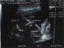 Baby Ultrasonic Sucking Thumb+-.jpg (17227 bytes)